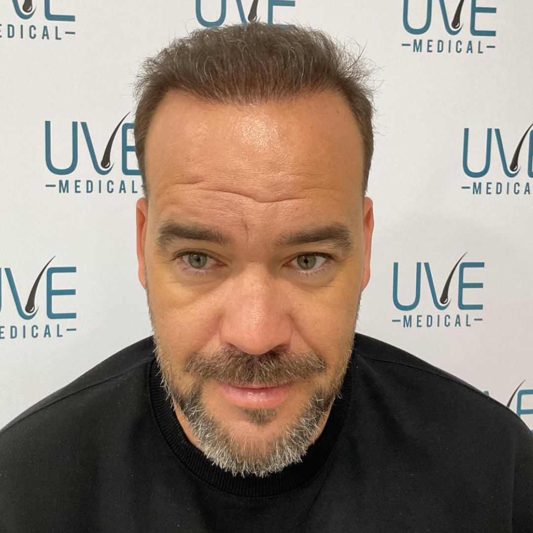 despues del proceso de injerto capilar