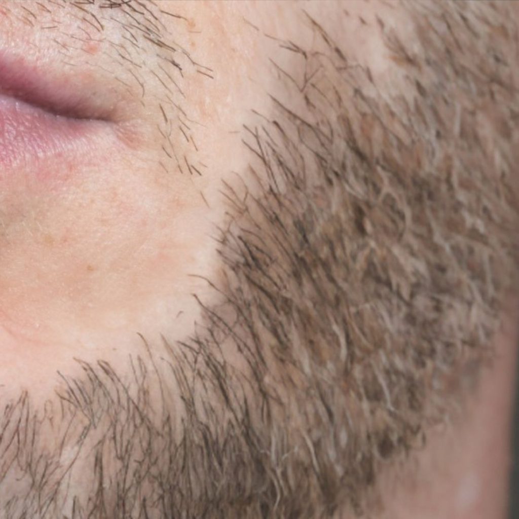 Despues de injerto de barba