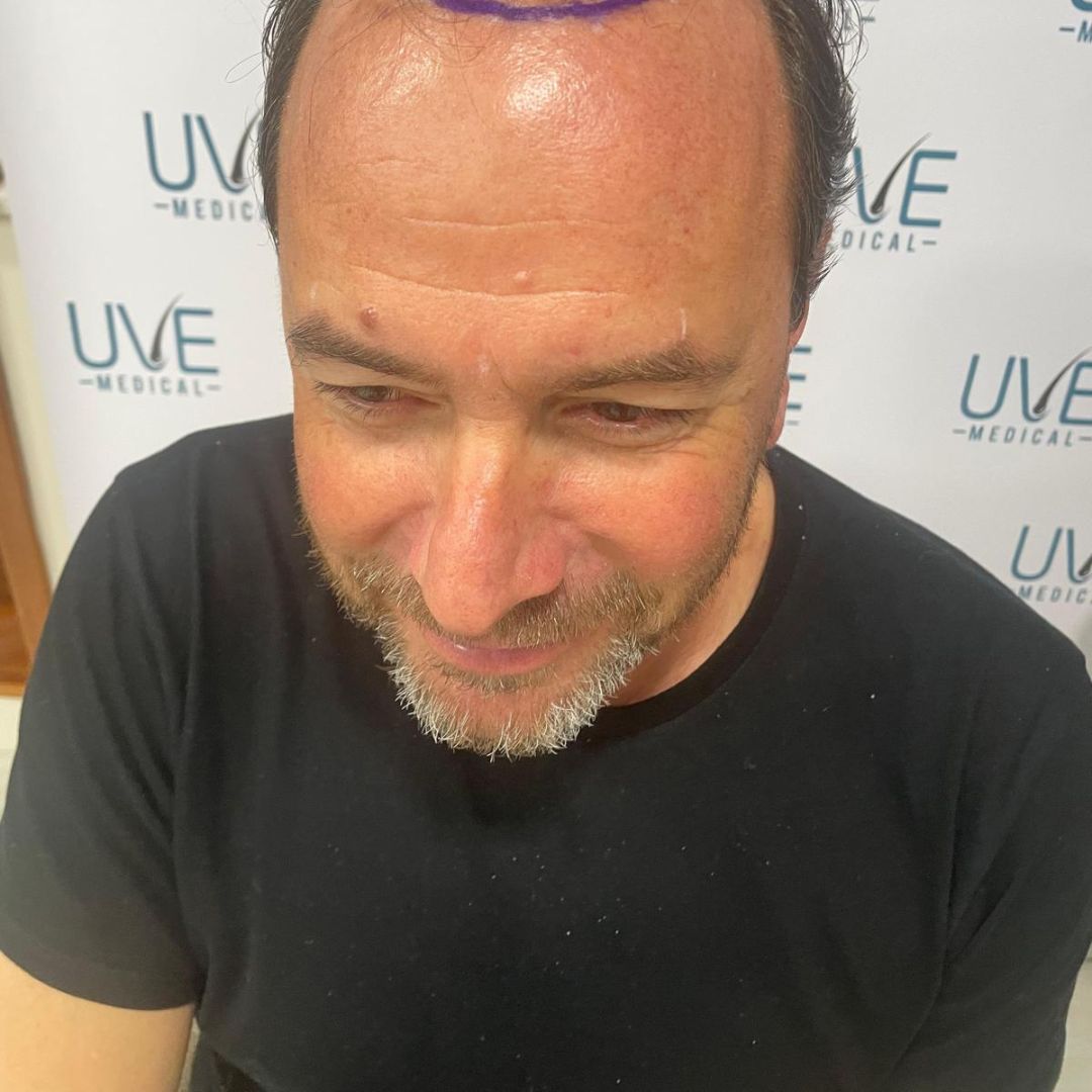 despues de injerto de cabello