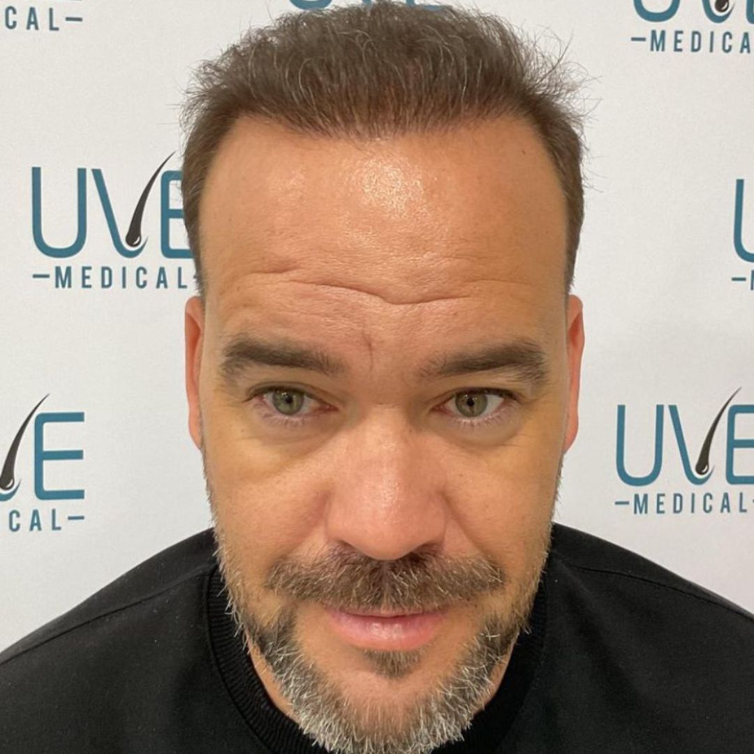 INJERTO CABELLO IMAGEN DESPUES