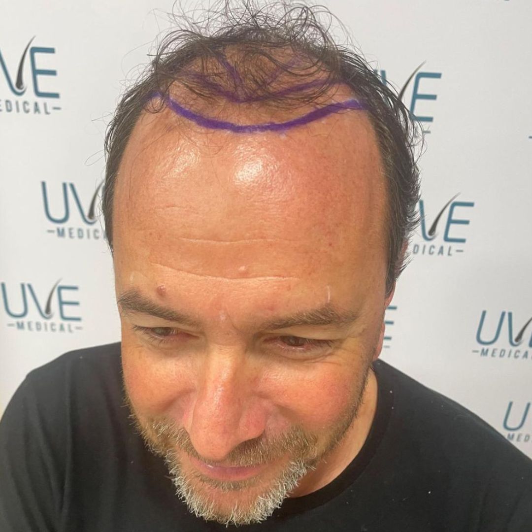 antes del injerto capilar