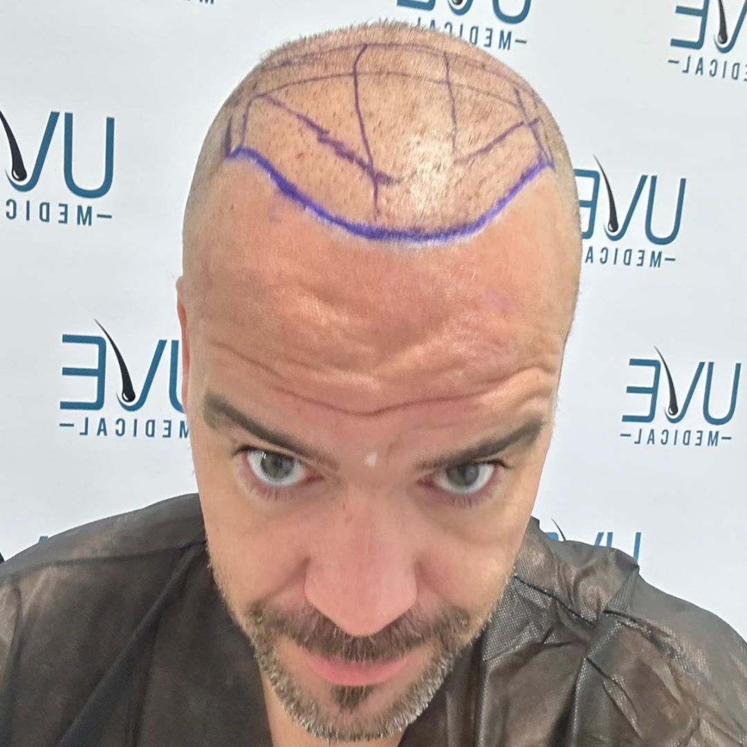 resultado de trasplante capilar en Madrid UVE Medical