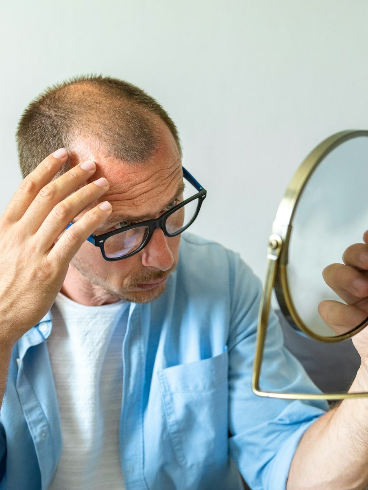 Male pattern hair loss problem concept. Young caucasian man looking at mirror worried about baldines